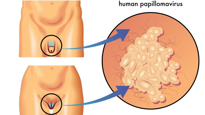 papilom condilom vagin hpv virus ansteckend
