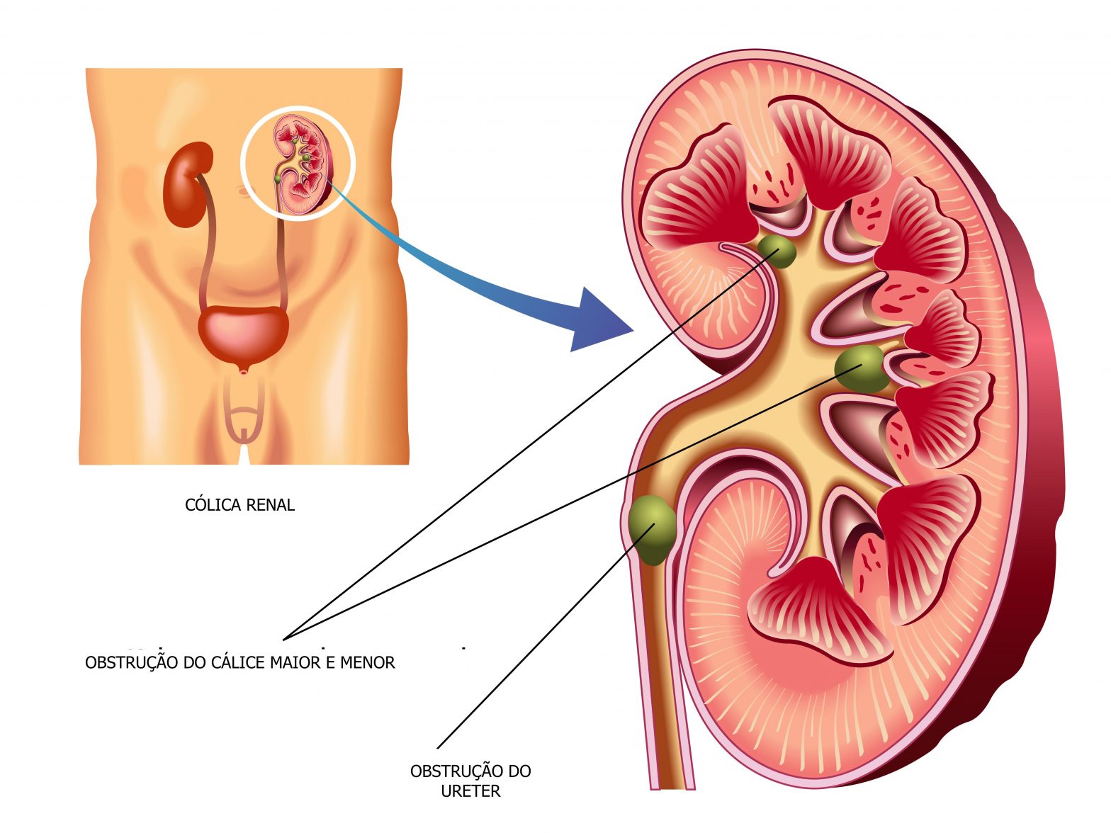 Litíase ou Cálculo Renal - Dr. Marcelo Thiel