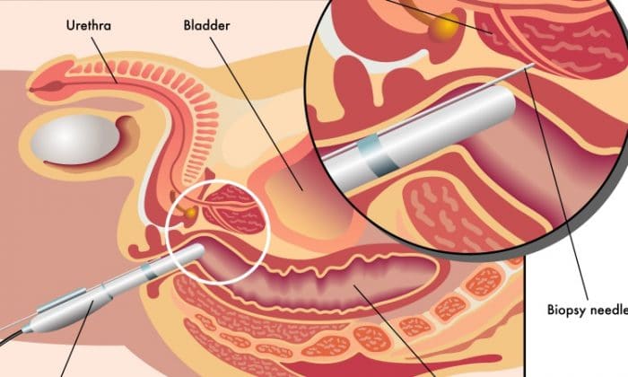 biopsia de próstata)