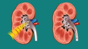 lithotripsy in kidney stones