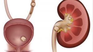Stones in the kidney, urinary bladder and ureter